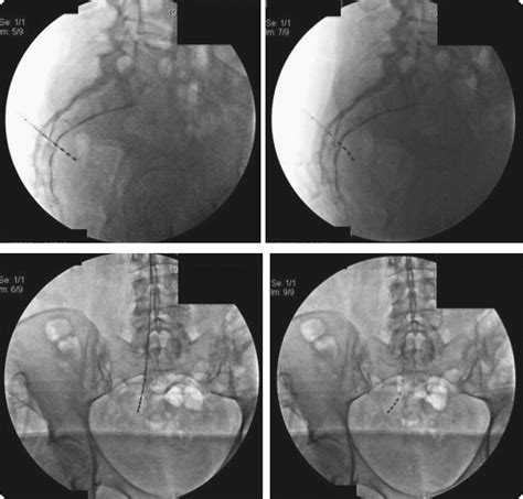 Sacral Nerve Stimulation For The Treatment Of Refractory Voiding And Bowel Dysfunction