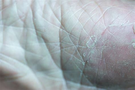 Problem of Dry, Cracked and Peeling Skin Stock Image - Image of dermatitis, human: 303121915