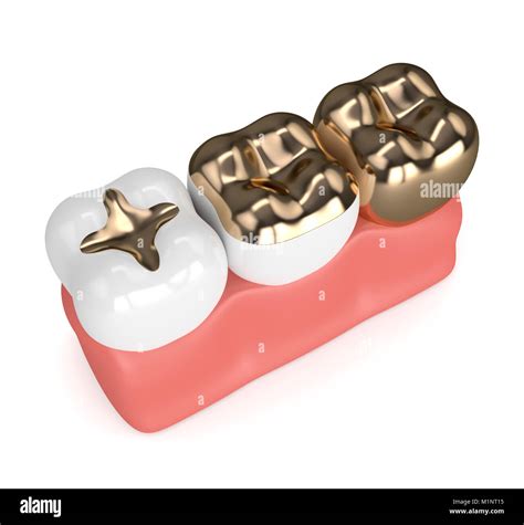 D Render Of Teeth With Inlay Onlay And Crown Gold Filling In Gums