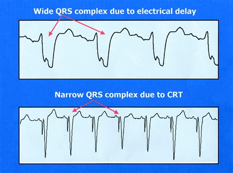 Cardiac Resynchronization Therapy A Patients Guide Circulation