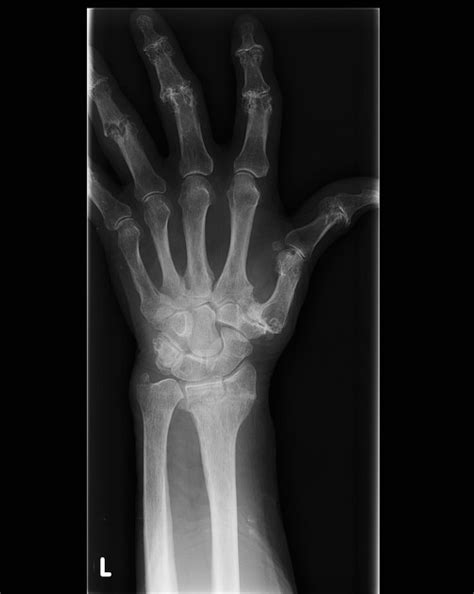 Frykman Classification Of Distal Radial Fractures Pacs