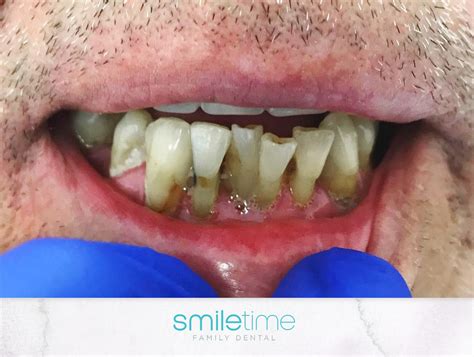 Case Studies Smile Makeover Gallery North Brisbane Dentist Photos