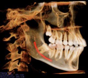 Coronectomy Procedure for Wisdom Teeth