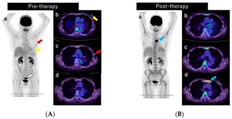 Diagnostics Free Full Text Focal Uptake In The Sternum On F Fdg