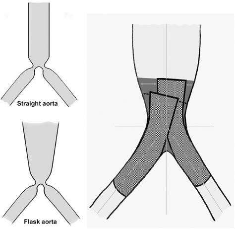 Figure 3 From Kissing Stent Reconstruction Of The Aortoiliac