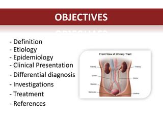 UPJ Obstruction Symptoms Causes Diagnosis And Ureteropelvic, 58% OFF