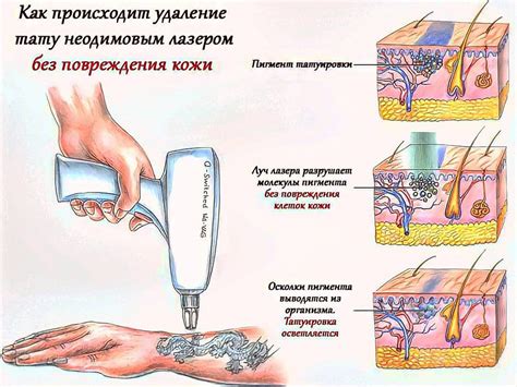 Удаление тату лазером - особенности процедуры