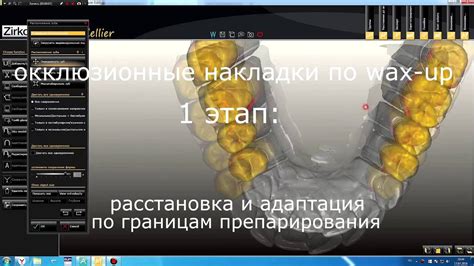 Изготовление окклюзионных накладок - YouTube