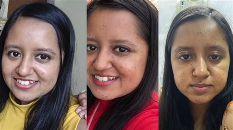 How to Remove ChickenPox Scars | Chicken Pox Scars Treatment | Dhruvi