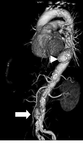 Figure 1 From Two Stage Endovascular Repair For Concurrent Penetrating