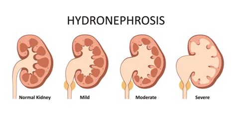 Hydronephrosis (Kidney Swelling) - Symptoms & Causes | Parkway East ...