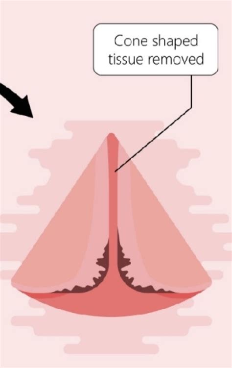 Bsccp Glandular Abnormalities Of The Cervix