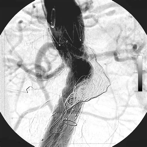 Effectiveness Of Intra Arterial Aneurysm Sac Embolization For Type Ia