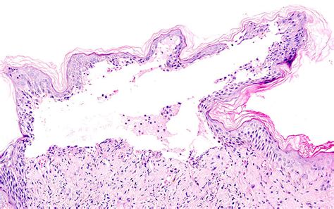 Histopathological Examination Revealed A Subepidermal Blister With Download Scientific Diagram