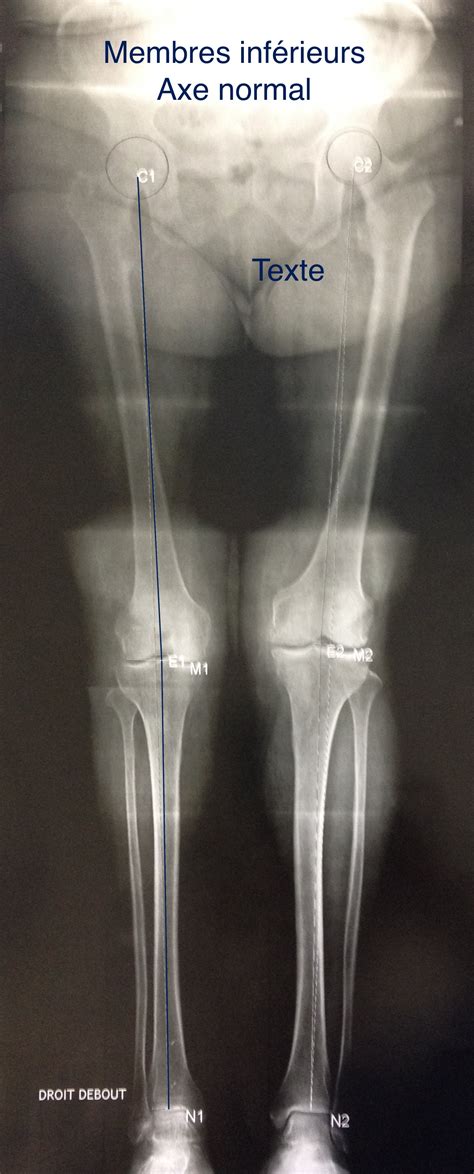Gonarthrose Chirurgie Orthopédique Sainte Marie