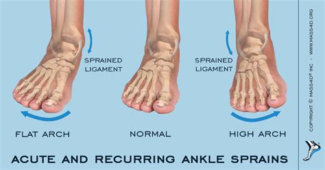 Ankle Sprain Treatment Symptoms And Prevention Mikkel Jarman