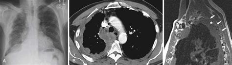 Pleural Tumors Radiology Key