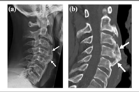 Figure 1 From Surgical Treatment Of Anterior Cervical Osteophytes Causing Dysphagia Semantic