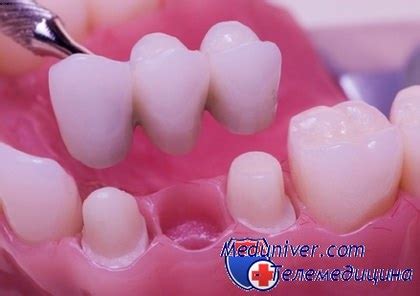 Протезирование зубов. Современные виды протезирования