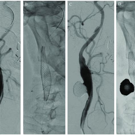 A Common Carotid Artery Cca Angiogram Revealed The Patient S