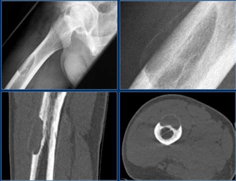 The Radiology Assistant Bone Tumor A G