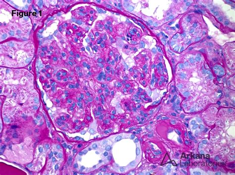 Proliferative Glomerulonephritis With Monoclonal Igg Deposits Pgmid