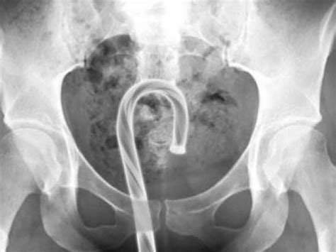 Masturbating With Christmas Ornaments X Rays Expose Stupid Sex Trend News Au