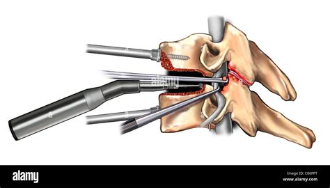 Cervical Nucleus Hi Res Stock Photography And Images Alamy