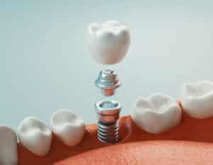 Impianti Dentali Cosa Sono E Come Vengono Inseriti Curasept S P A