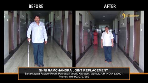 Yrs Success Story Of Total Hip Replacement By Sivaiah Potla M S