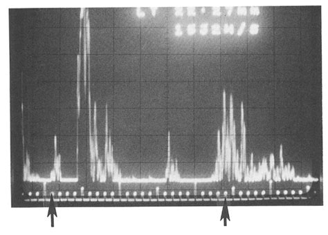 Hoffer Ultrasound A Scan Photograph Using Very Low Sound Amplitude