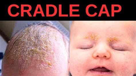 What Is Cradle Cap Symptoms Causes Treatment Youtube