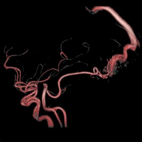 Cerebral Arteriovenous Malformation Pacs
