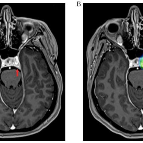 (A) Brain MRI with I/V contrast. The red arrow indicates homogeneous... | Download Scientific ...