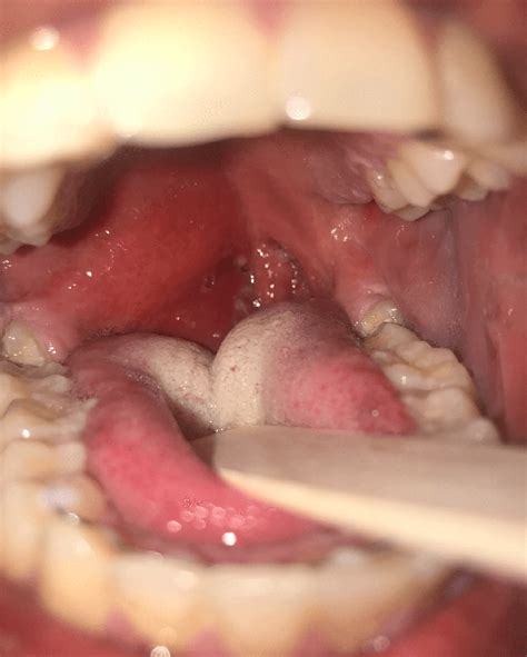 Peritonsillar Abscess