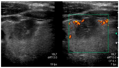 Follicular Thyroid Cancer Ultrasound