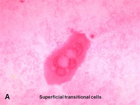 american urological association normal transitional cells