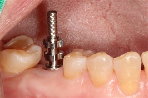 Transfer Type Impression Using Healing Abutment Download Scientific Diagram