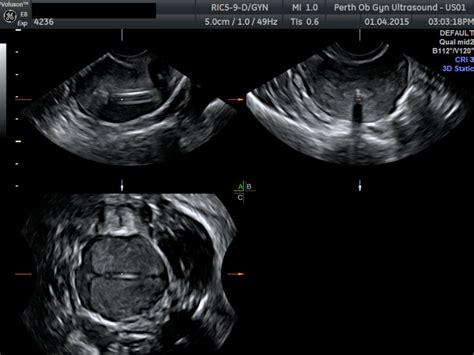 Pelvic Ultrasound - POGU