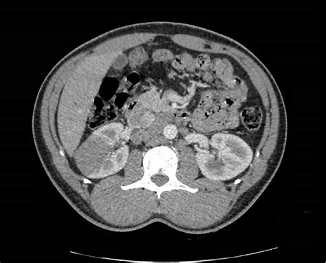 Histological Features Of The Radical Nephrectomy Of The Right Kidney