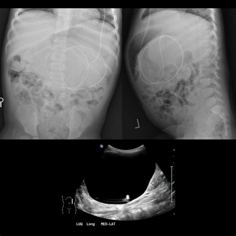 Preschooler With 2 Weeks Of Abdominal Distension Pediatric Radiology