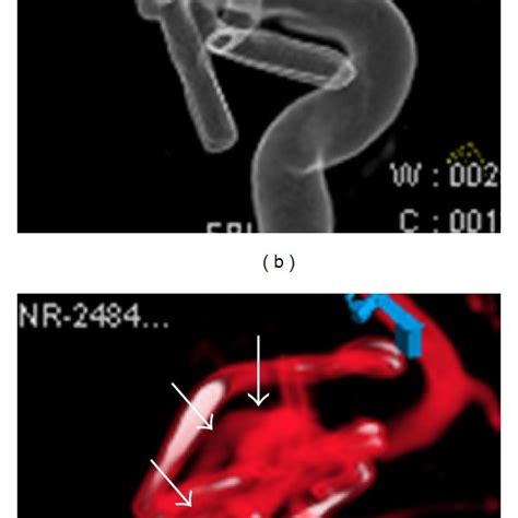 D Digital Subtraction Angiography A And Surface Shaded Display B