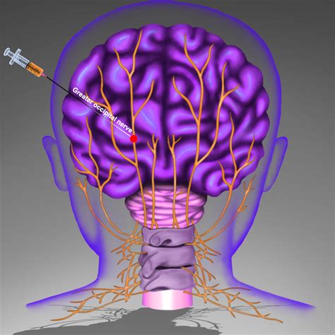 Migraine Nerves Greater Occipital Nerve Block