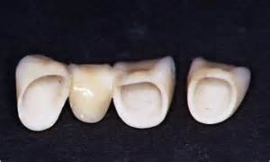 Керамическая коронка оксид алюминия