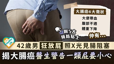 大腸癌︳42歲男狂放屁照x光見腸阻塞揭大腸癌 醫生警告一類屁要小心︳附6大徵狀5招預防 晴報 健康 腫瘤及癌症 D220913