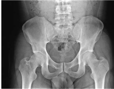 Blurring Of The Cortical Margin Of The Subchondral Bone And Sclerotic