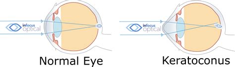 Keratoconus Management Eye Test And Vision Care Infocus Optical