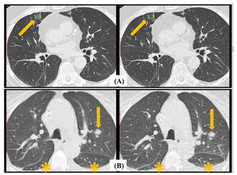 Jcm Free Full Text Diagnostic Accuracy In Detecting Fungal