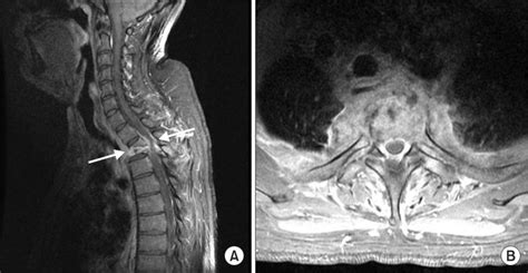 A Sagittal Contrast Enhanced T1 Weighted Magnetic Resonance Image Of