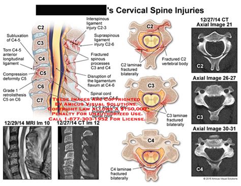 amicus illustration  amicusinjurycervicalspinecccccc